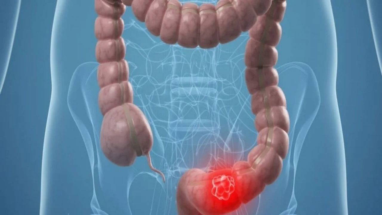 Uzmanından uyarı: Bağırsak kanseri gençlerde de artıyor
