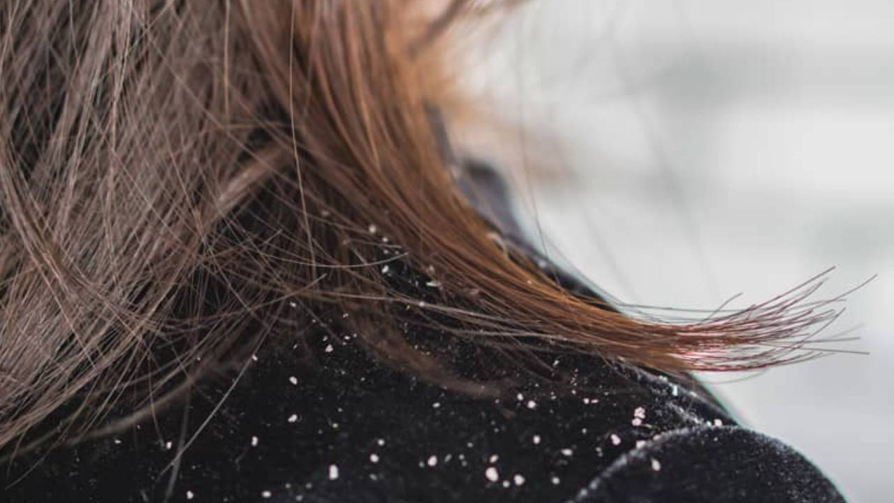 Geçmeyen kepek cilt hastalıklarının sinyali olabilir