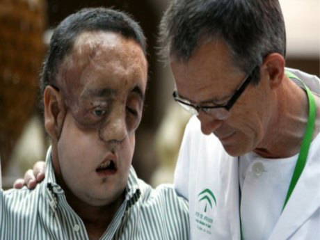 İspanya'da ilk yüz nakli