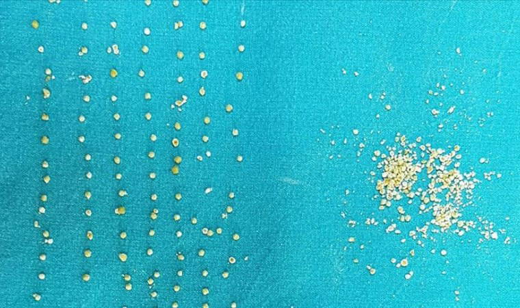 Safra kesesinden 200 taş çıkarıldı