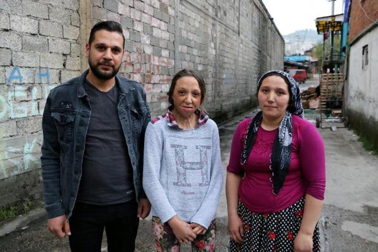 Vücudu ve yüzü yanan Yağmur, yardım bekliyor