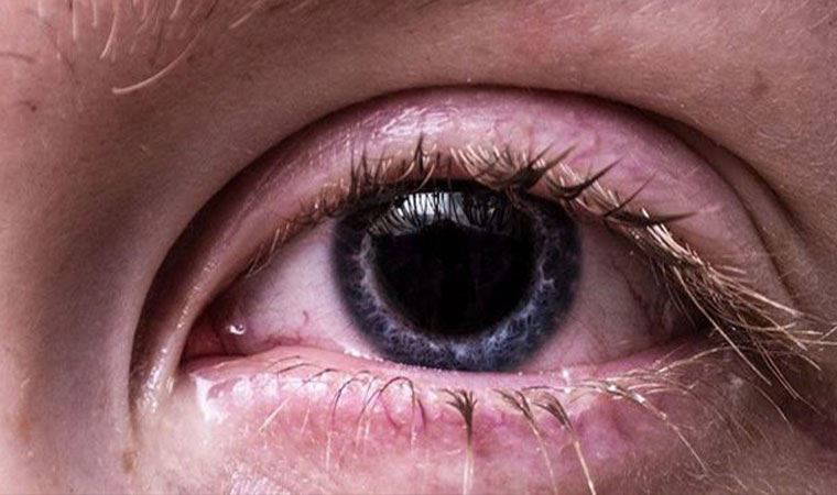 Koronavirüs belirtileri gözlerde de görülebiliyor
