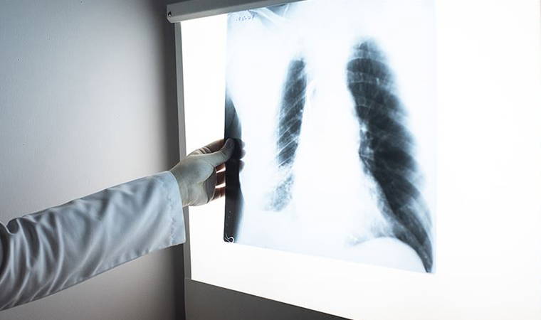 Uzmanından kritik uyarı: 'Pişen yemeğin dumanı bile KOAH nedeni'