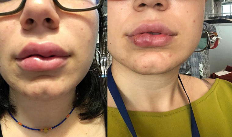 Dudak dolgusu faciası: 250 bin TL’lik dava açarak doktordan şikayetçi oldu