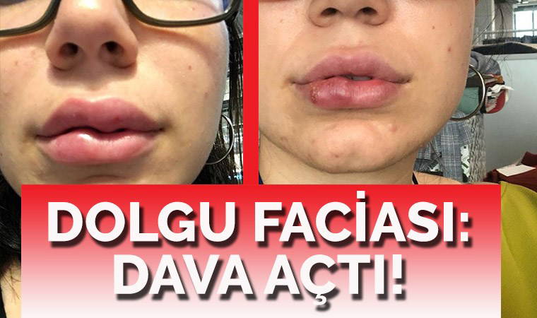 Dudak dolgusu faciası: 250 bin TL’lik dava açarak doktordan şikayetçi oldu