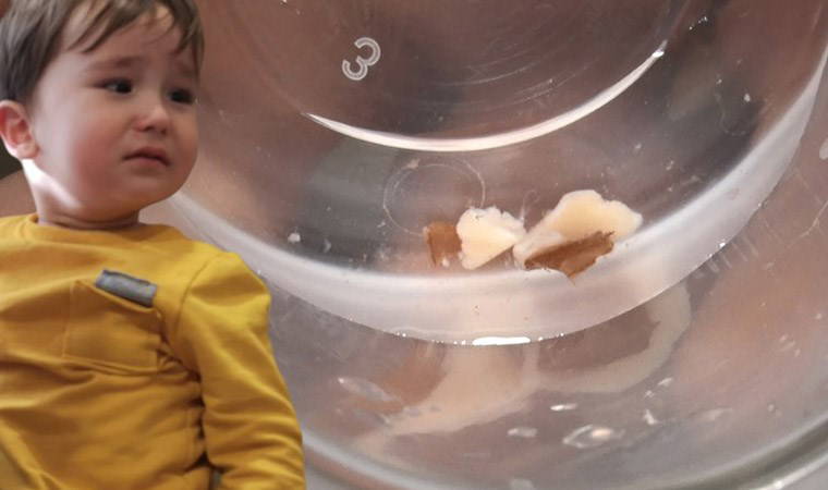 'Zatürre' sanılan çocuğun akciğerinden badem parçaları çıkarıldı