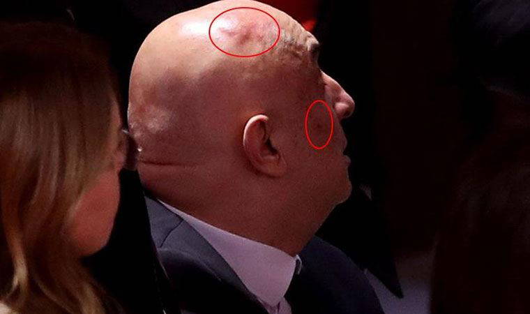 Meclis'teki kavga sonrası Özkoç’un yüzünde ve kafasında şişlik oluştu!