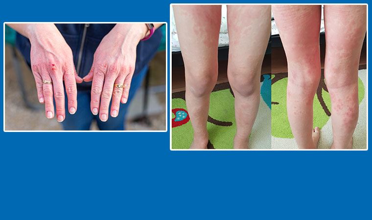 Dikkat! Kurdeşen de koronavirüs belirtisi olabilir