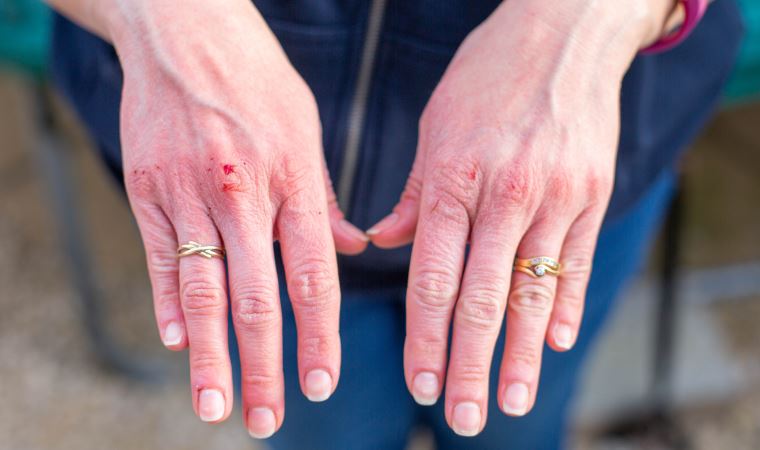 Dikkat! Kurdeşen de koronavirüs belirtisi olabilir