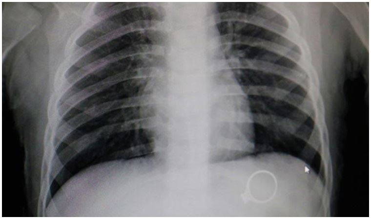 Annesinin 3 bin liralık tek taş yüzüğünü yuttu!