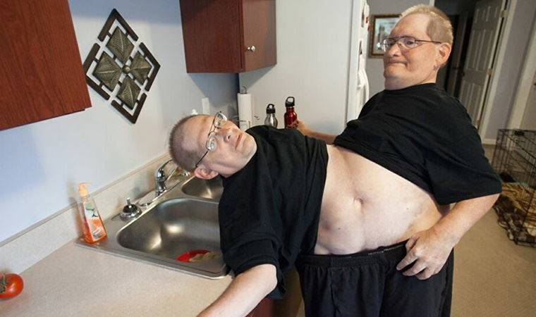 Dünyanın en uzun süre hayatta kalan yapışık ikizleri Ronnie ve Donnie Gaylon, 68 yaşında hayatlarını kaybetti
