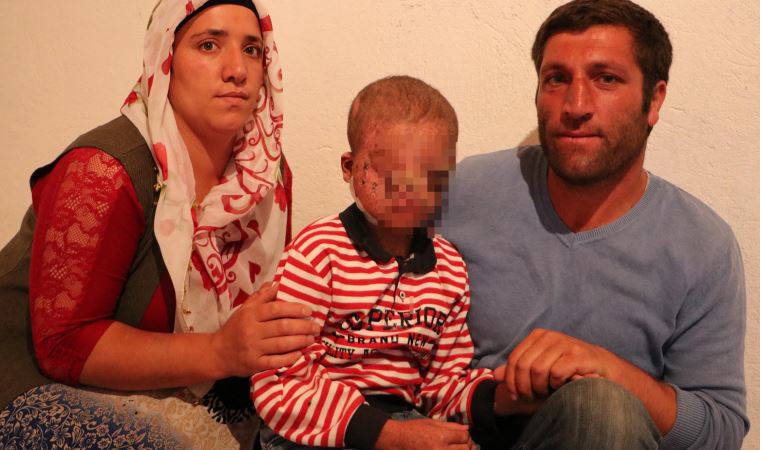 Cilt kanseri henüz 8 yaşında, gün ışığına çıkamıyor...  