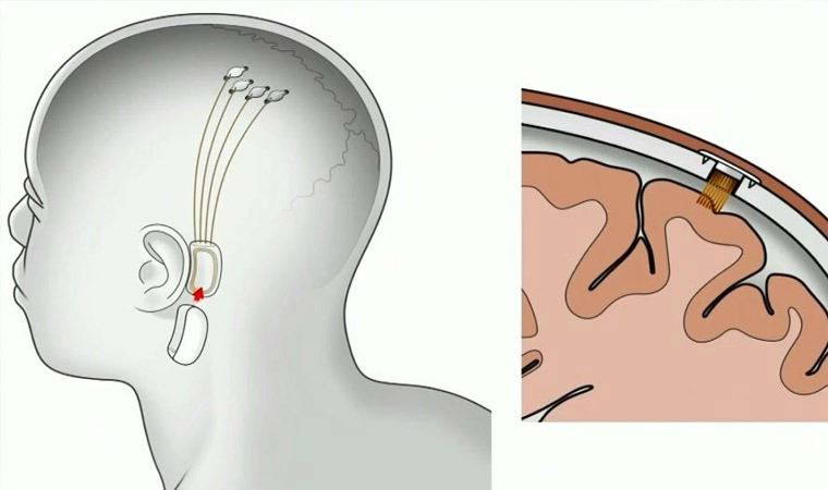 Beyin pillerinin yerini Musk’ın çipi mi alacak?