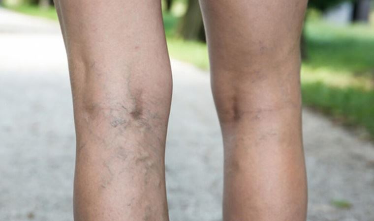 Varis nedir, neden oluşur?