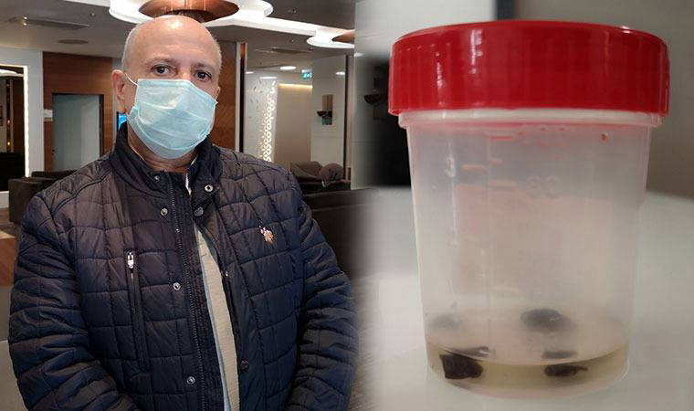 Kanser sandılar, biyopsi bile yapıldı; akciğerinden 32 yıl sonra çam fıstığı çıktı