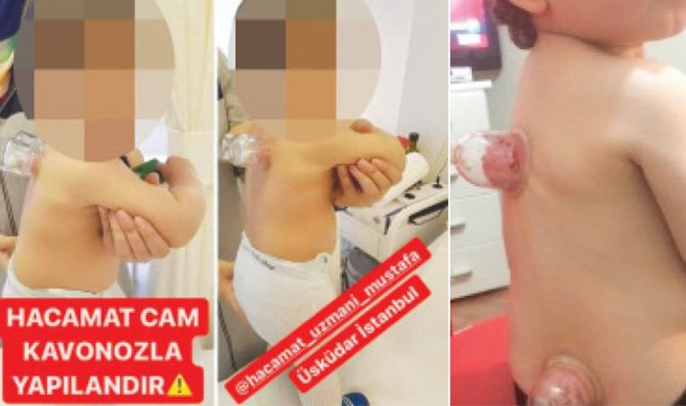 Bebeklere de hacamat yapıyorlar!