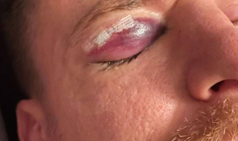 Serdar Aziz'in gözünden yaşadığı sakatlığın son hali korkuttu