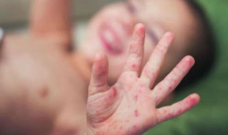 DSÖ’den 'kızamık' uyarısı: Sekteye uğratabilir