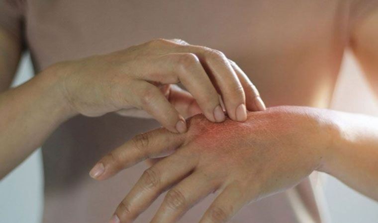 Pandemi ve yoksulluk uyuz vakalarını artırdı