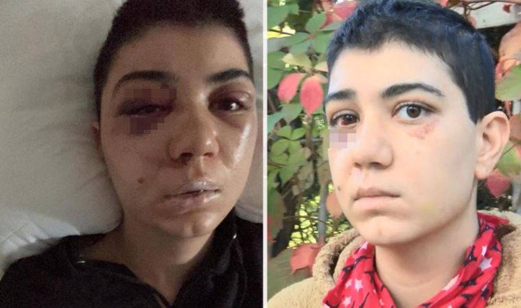 Bacaklarını çekmesi için uyardığı kişi tarafından darbedildl