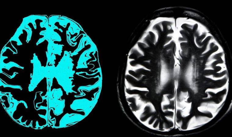 AB, Alzheimer tedavisi için geliştirilen ilaca kullanım onayı vermedi