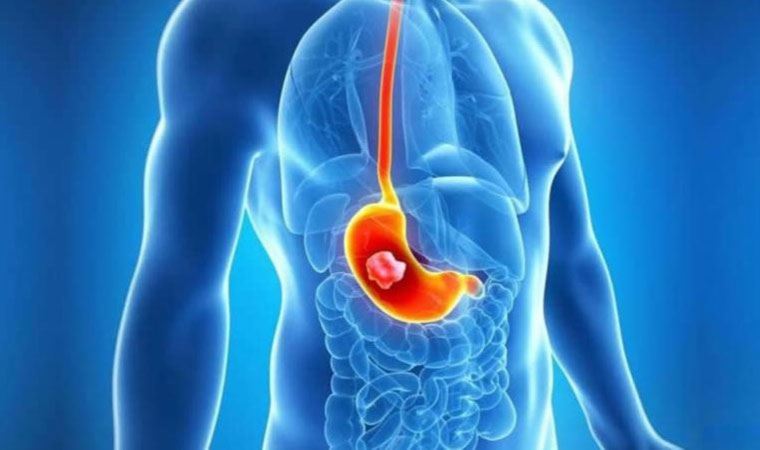 Mide kanseri nedir, belirtileri nelerdir?