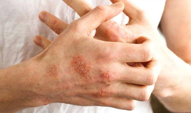 El dezenfektanları egzamaya davetiye çıkarıyor