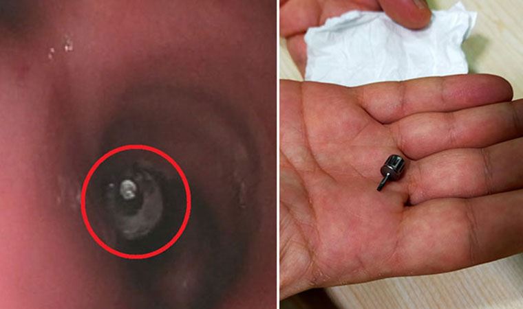 Dişçide akciğerine implant parçası kaçtı