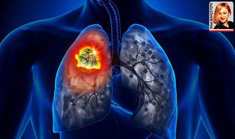 Akciğer kanseri dünyada en sık ortaya çıkan ikinci kanser