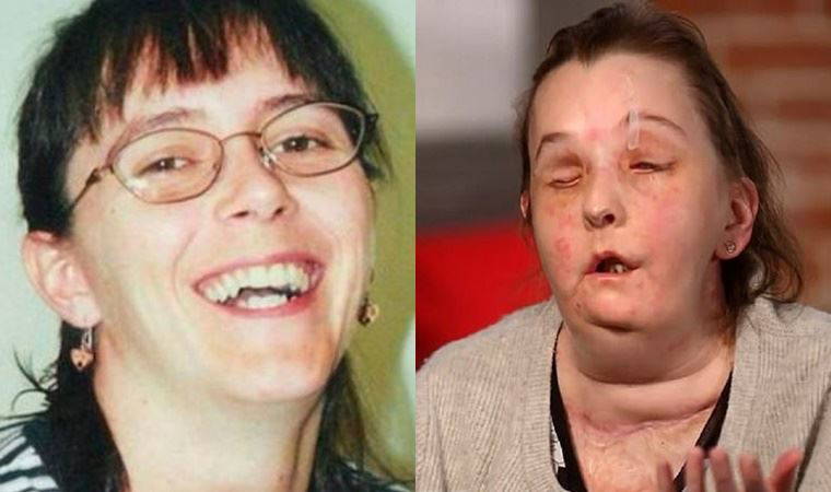 ABD’de ikinci kez yüz nakli yapılan kadın ilk kez basın karşısında