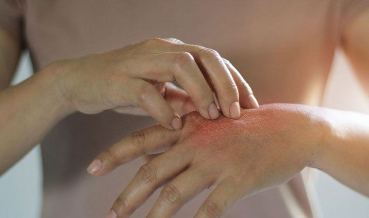 Pandemi döneminde 'uyuz' vakaları arttı