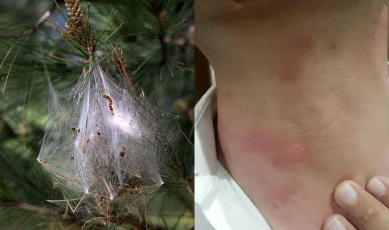 Uzmanı uyardı: 'Çam kese tırtılı hastanelik edebilir'