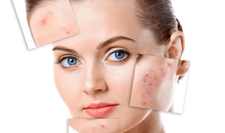 Gençlerin mutsuzluk sebebi: Sivilce-akne