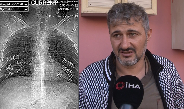 Şiddetli öksürük şikayetiyle hastaneye gitti, kaburgalarının kırıldığını öğrendi