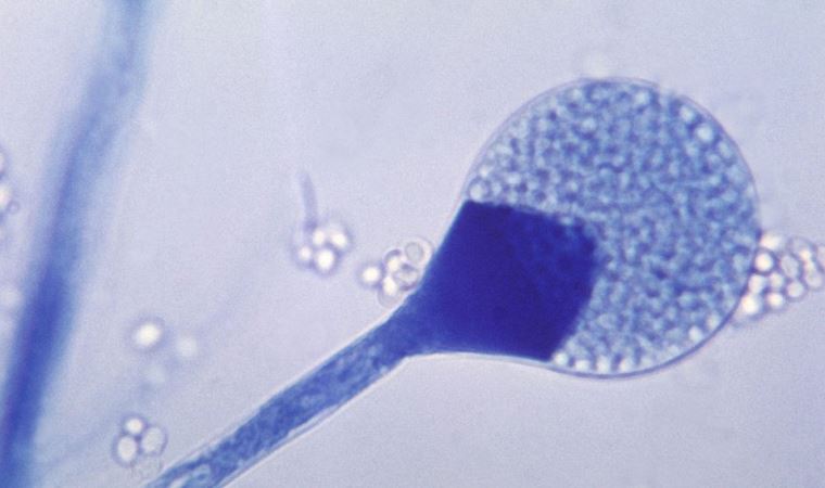 Kara mantar hastalığı: Belirtileri neler, Hindistan'da neden yayılıyor?