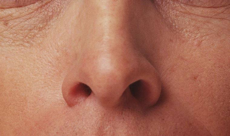 Burun tıkanıklığı neden olur, burun tıkanıklığına ne iyi gelir?