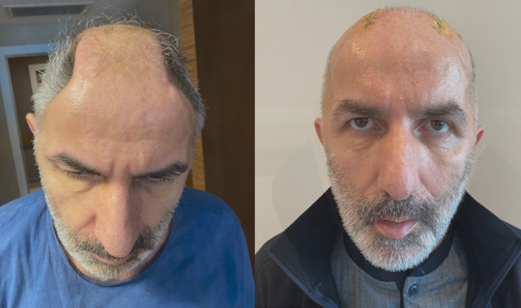 Kafatası kemiklerini 5 ay karnında taşıdı