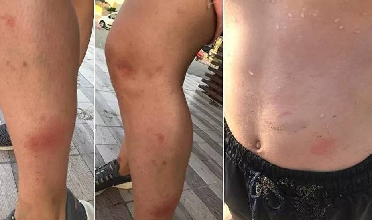 Denize giren herkeste kaşıntı başlamıştı: Nedeni belli oldu