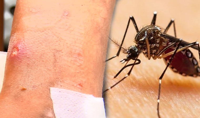 İstanbul'da görülen Asya Kaplan sivrisineğine dikkat