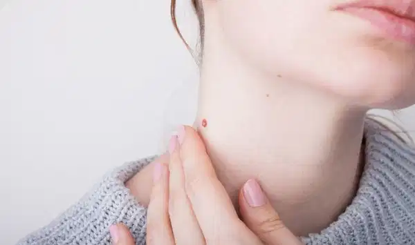 Uzmanı anlattı: Her siğil kansere neden olmaz