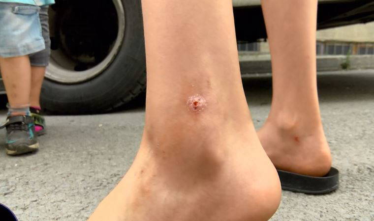 Avcılar'da sivrisinek kabusu; çocuklarda yaralar oluştu