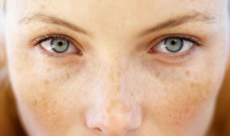 Güneş lekesi nedir? Güneş lekesi nasıl geçer?