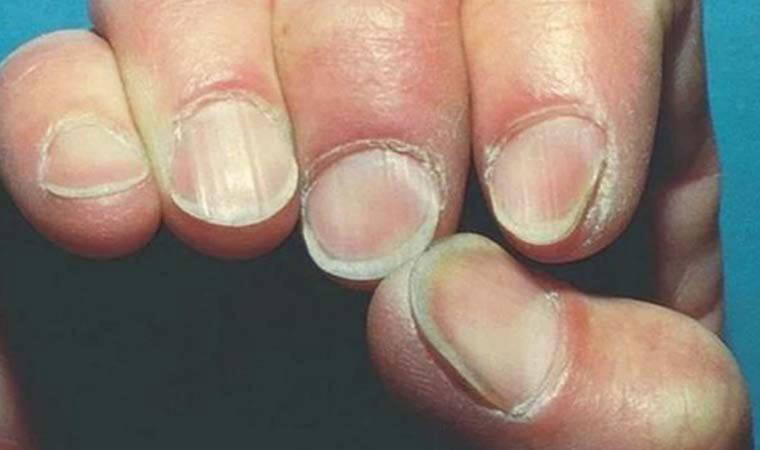 Tırnak sararması nedir? Tırnak sararması neden olur? Tırnak sararması nasıl tedavi edilir?