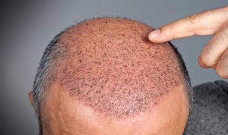 Saç ekiminde doğru bilinen yanlışlar