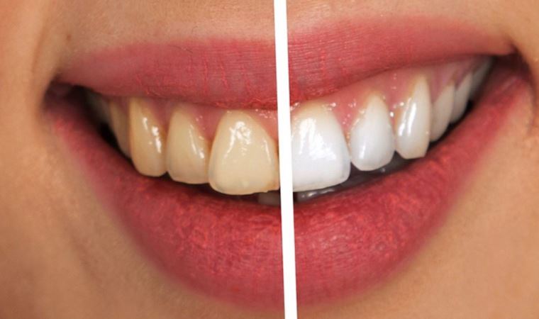 Bilinçsiz yapılan 'ağartma işlemi' dişlere kalıcı hasar veriyor