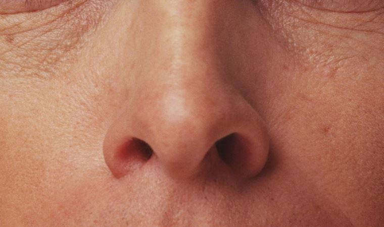 Burun hastalıkları hayat kalitesini olumsuz etkiliyor