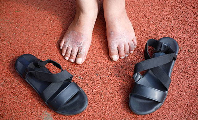 Ayaklarında yara oluşan kadının 