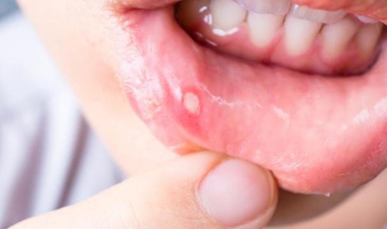 Uzmanı uyardı: Ağızdaki yaralar dil kanseri işareti olabilir