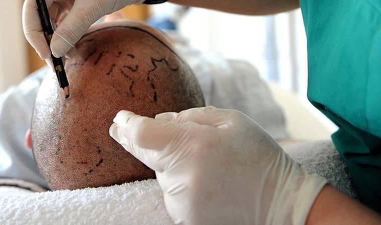 Saç ekim merkezleri için korkutan iddia: Saç ekim merkezlerinin yarısı doktorsuz işlem yapıyor