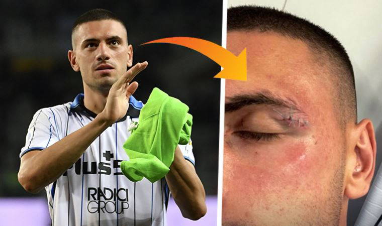 Salernita - Atalanta maçında milli futbolcu Merih Demiral, kanlar içinde kaldı
